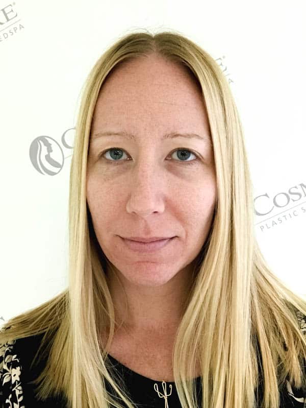 before photo of woman's skin before microneedling treatment at Costmeticare