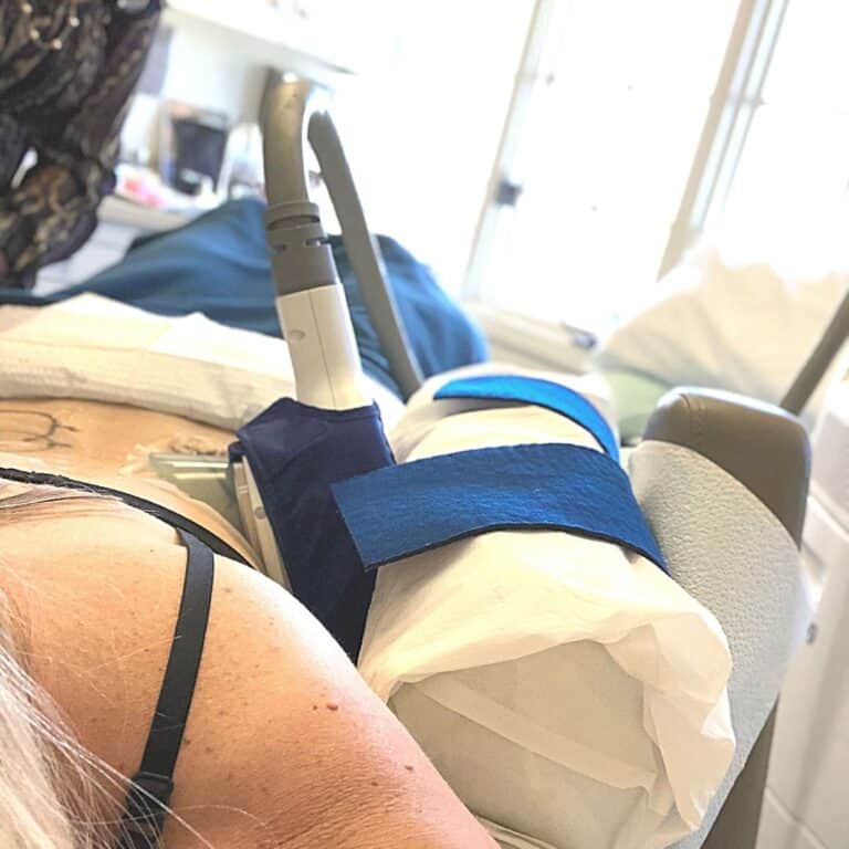 My Coolsculpting Results with Before and After Pictures